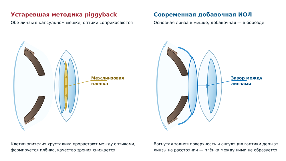 Чем добавочная ИОЛ отличается от методики piggyback